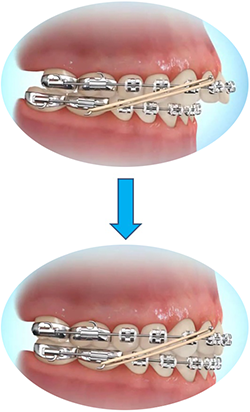How do elastic rubber bands for braces work? - Dental Health Clinic