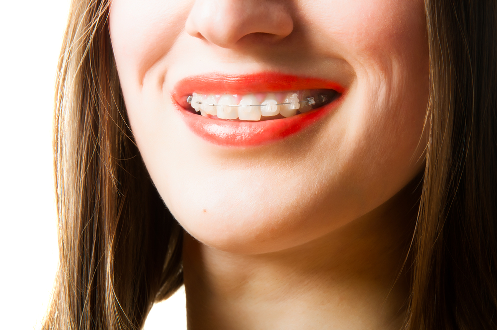 A Surge in the Popularity of Adult Braces - Belmar Orthodontics