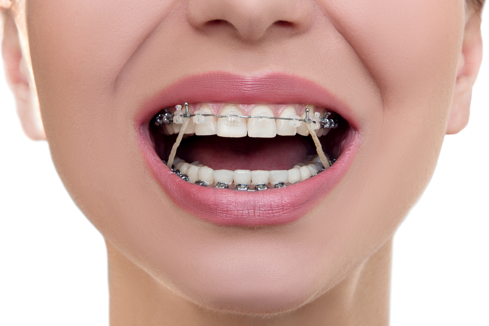 How Orthodontic Elastic Bands Work 
