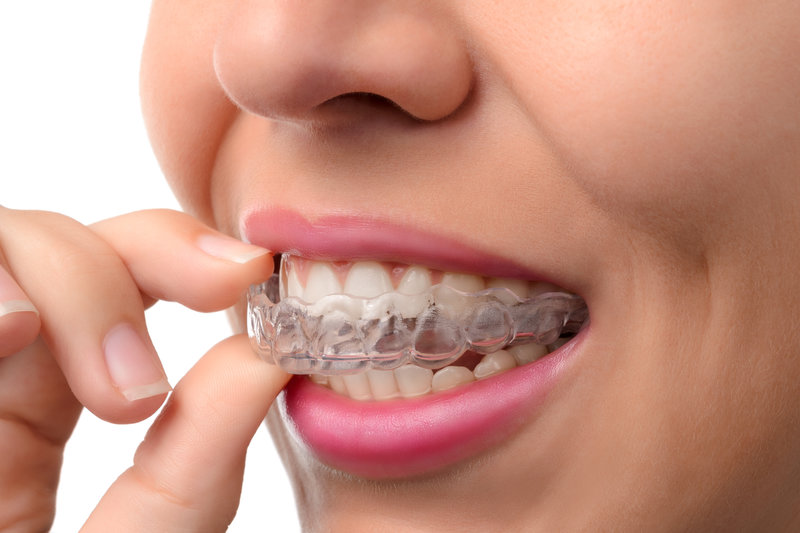 Fixed braces with ceramic brackets hi-res stock photography and