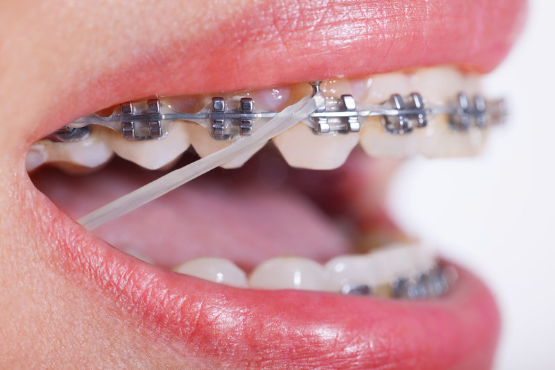 Everything You Need to Know About Custom Braces