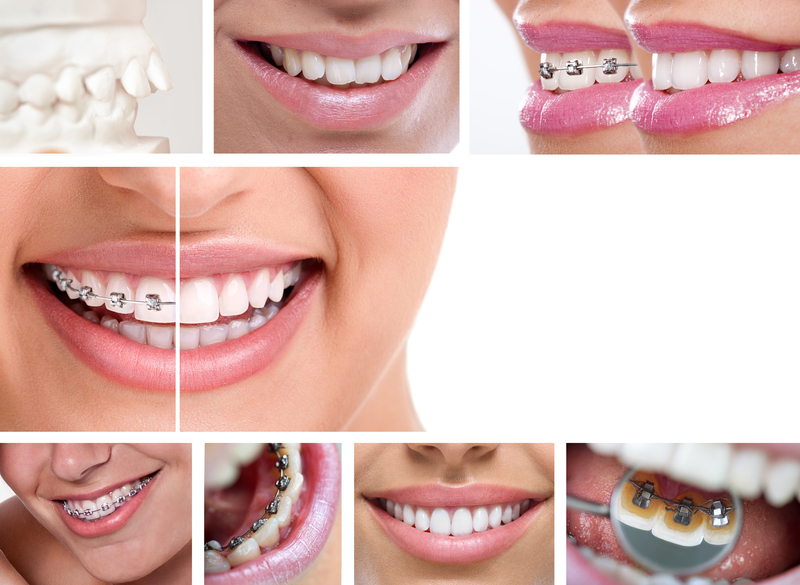 Know Your Orthodontic Options - Belmar Orthodontics