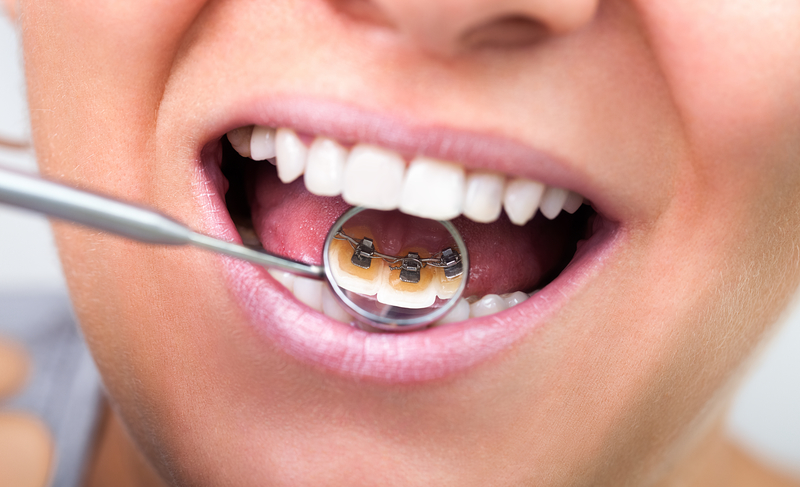 Are Dental Braces better right for you over Invisalign - Silver Smile Dental