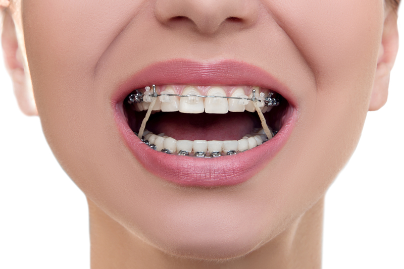 Braces Colors: Everything You Need To Know - Hardy Orthodontics