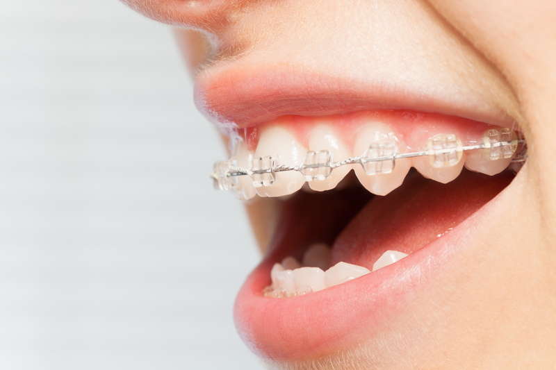 Braces Elastics (Rubber Bands) for Bite Correction and Alignment