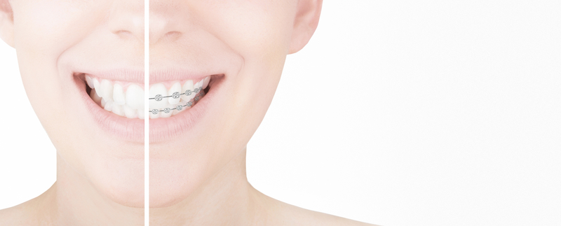 The Impact Of Straight Teeth On Oral Health - Belmar Orthodontics