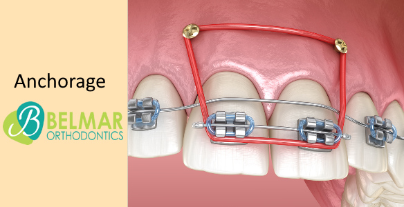 How Orthodontic Elastic Bands Work - Belmar Orthodontics